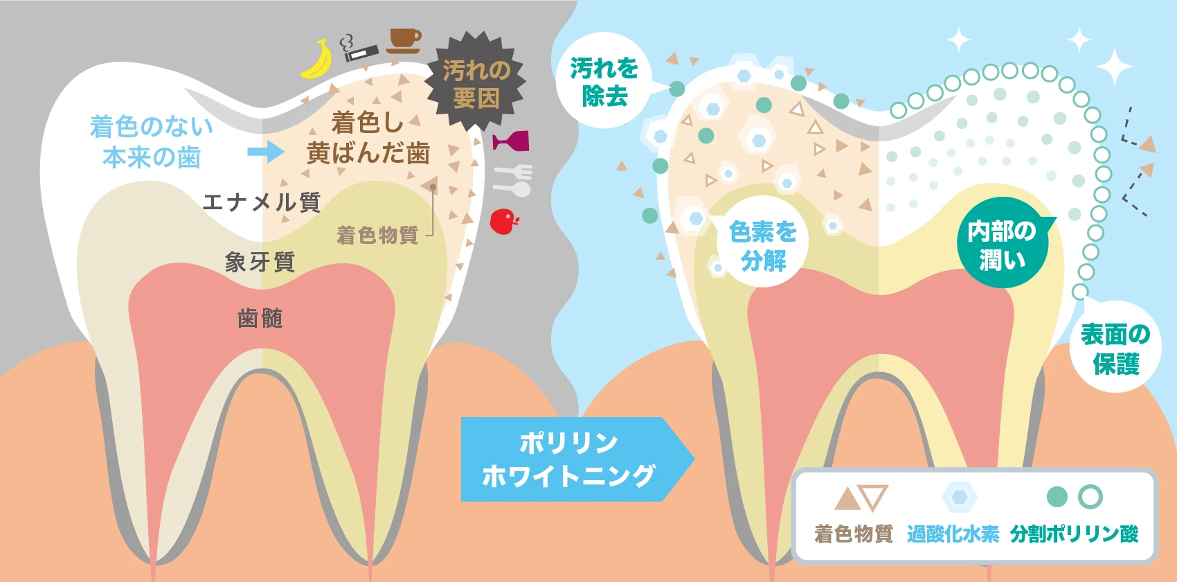 弁天町やまうち歯科でホワイトニング